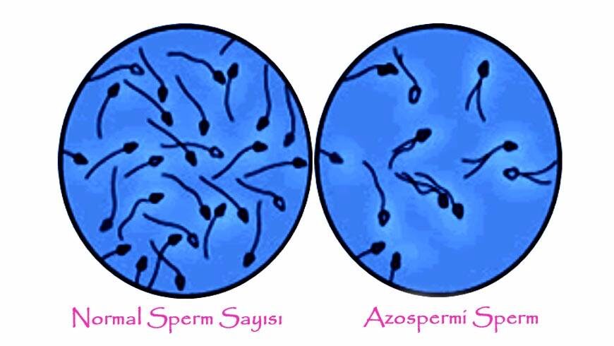 IVOX IVF Nord Zypern Klinik 26 Azoospermie