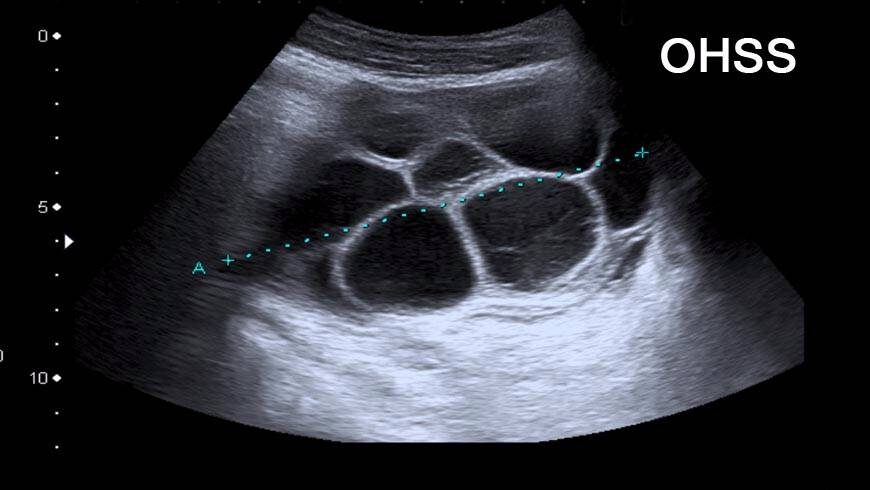 Ovarielles Hyperstimulationssyndrom